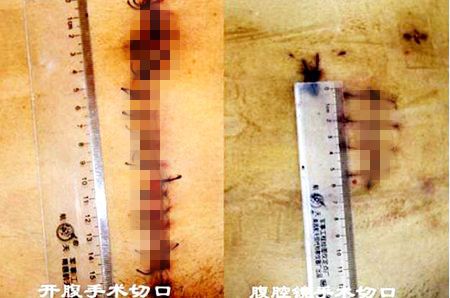 河南省治疗直肠癌最好的中医专家,直肠癌不做手术