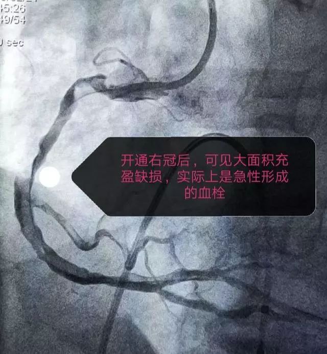 急性心肌梗死院前急救的急救措施,中医治疗急性心肌梗死的急救方法