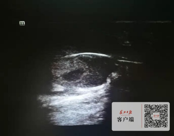 久坐臀部长了脓包,男子屁股上长痘痘