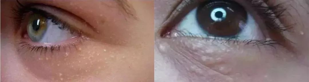 涂眼霜会不会长肉粒,涂眼霜会不会导致眼袋越来越严重