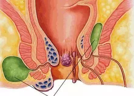 肛周脓肿科普,肛肠痔疮科普