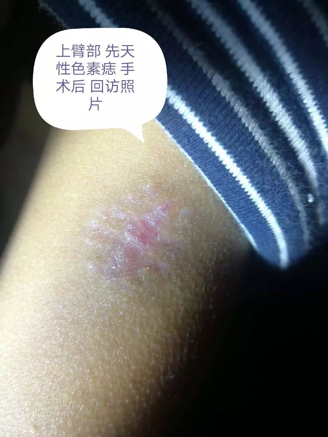 小小黑痣该不该治？该如何治？