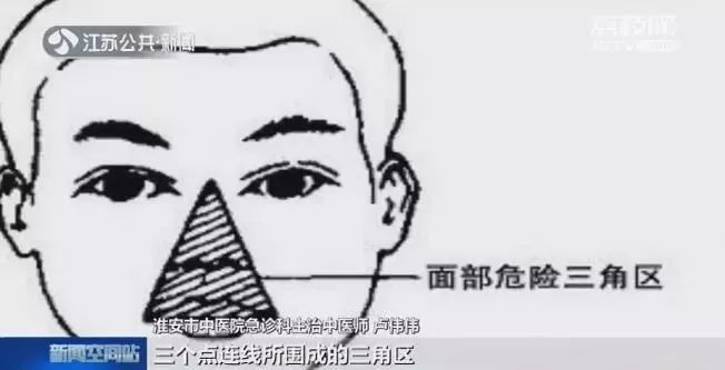 女子挤痘痘致感染被送急诊,女子挤痘痘进icu