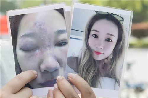 女子鼻部注射玻尿酸导致失明,打玻尿酸隆鼻子失败案