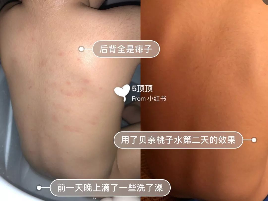 一瓶水止痒,后背长痱子很痒怎么解决
