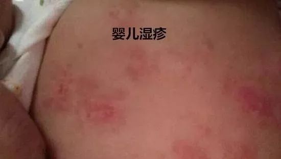 婴儿湿疹和热疹的区别在哪里,婴儿湿疹和热疹区别在哪里