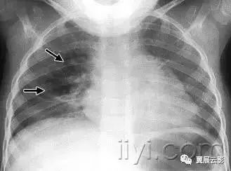 胸部解剖及常见疾病影像表现,胸部影像学基础知识