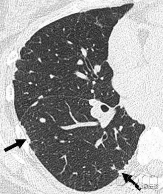 胸部解剖及常见疾病影像表现,胸部影像学基础知识