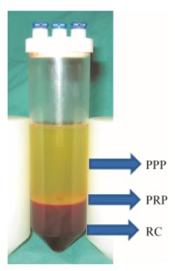 富血小板血浆技术治疗适应症,富血小板血浆计数的目的和意义