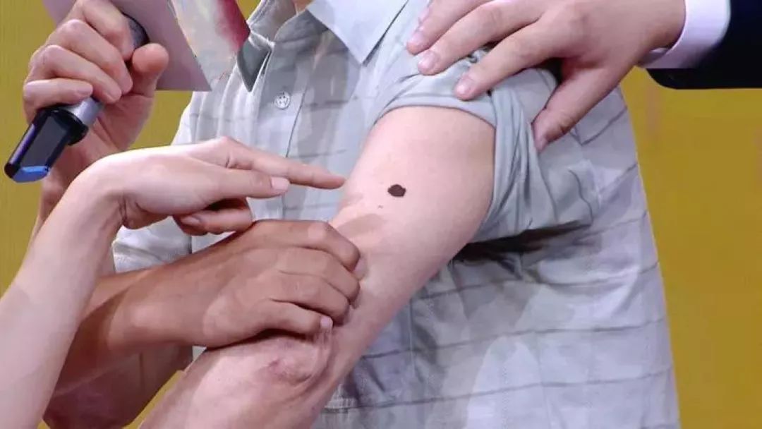 注意身上有这种黑痣要立刻就医,黑痣注意事项