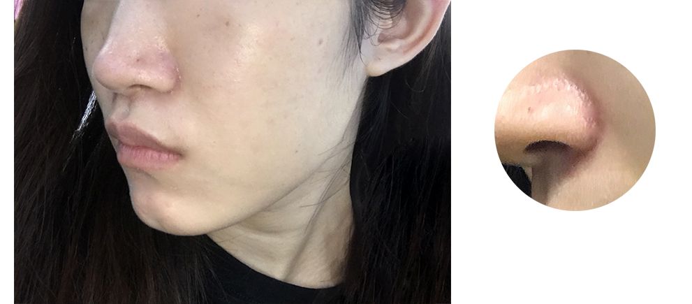 水光针副作用这么可怕,水光针有什么医疗隐患吗