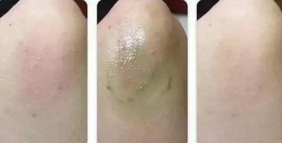 泰国蚊子叮咬止痒膏,泰国清凉膏蚊子