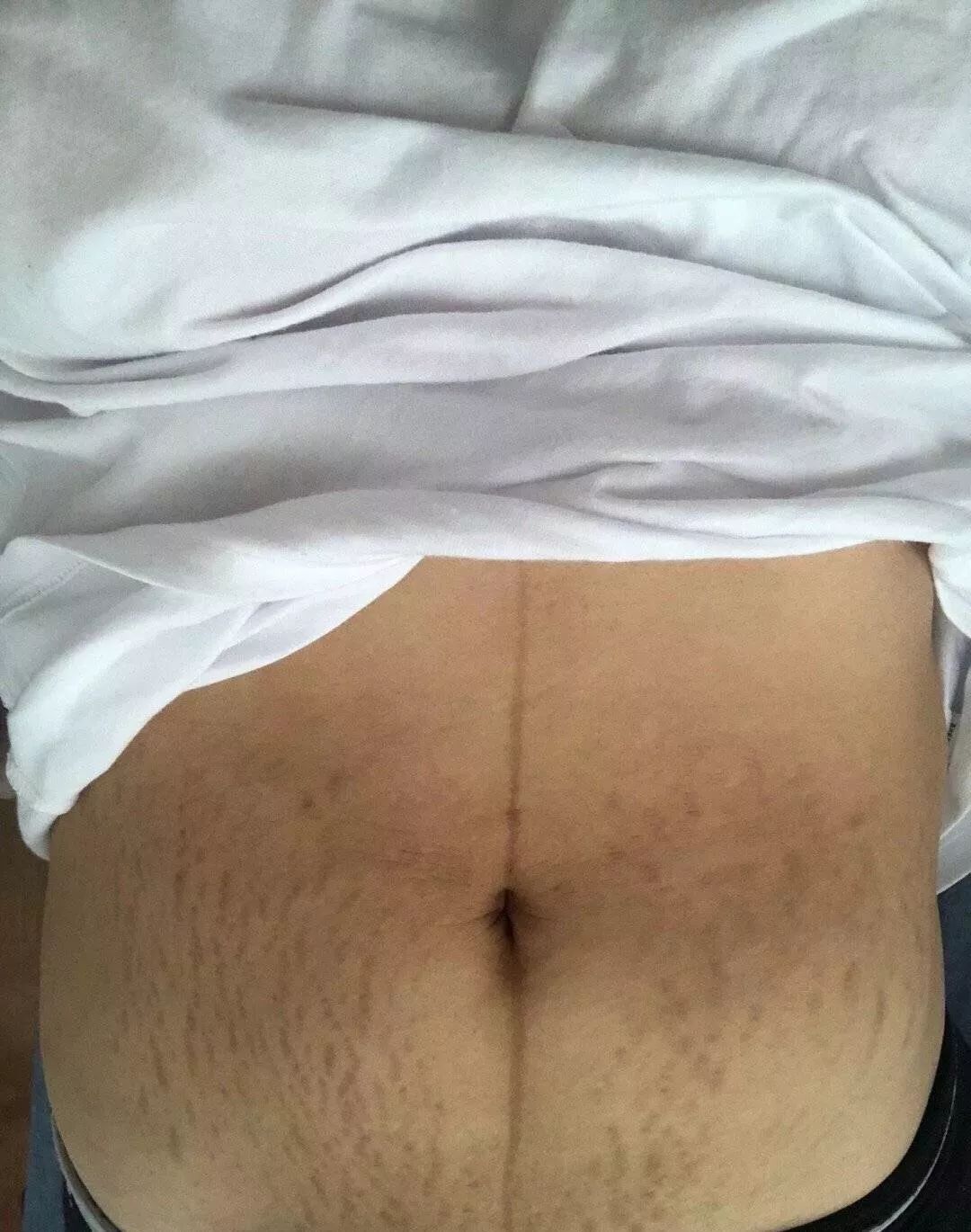 生育后尿失禁的后遗症,生育前没有人会告诉你的事