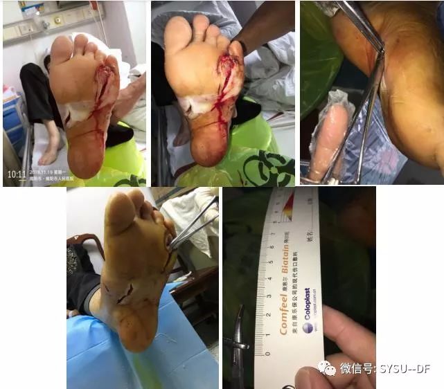 负压吸引糖尿病足的应用,负压滴灌治疗糖尿病足优势是什么