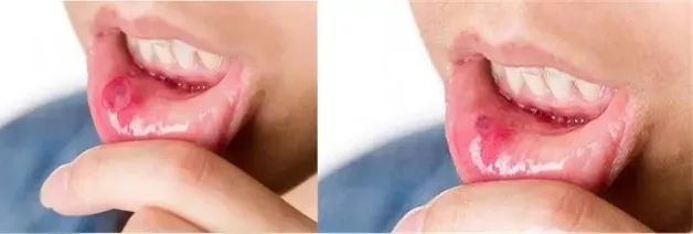 牙龈肿了出血口臭牙黄用什么牙膏,牙龈上火牙膏