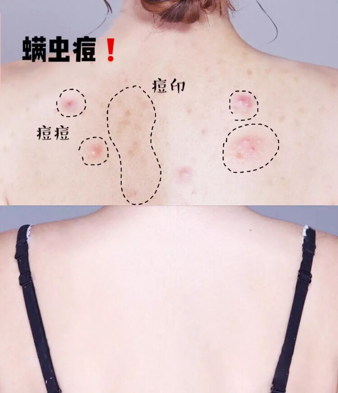 鼻尖挤出白色的是什么,鼻子上挤出的白丝怎么解决