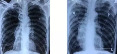 支气管镜热消融术治疗慢阻肺,西京医院支气管镜