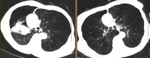 支气管镜热消融术治疗慢阻肺,西京医院支气管镜