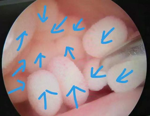 男子肩膀发现豌豆大结节,左肩上方一块肿大是怎么回事