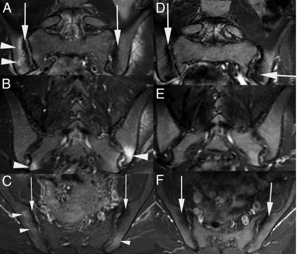 双侧骶髂关节炎会导致葡萄膜炎吗,骶髂关节炎伴发葡萄膜炎