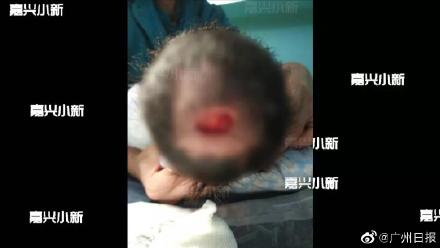 婴儿头上少一块皮肤,婴儿头上少块皮肤