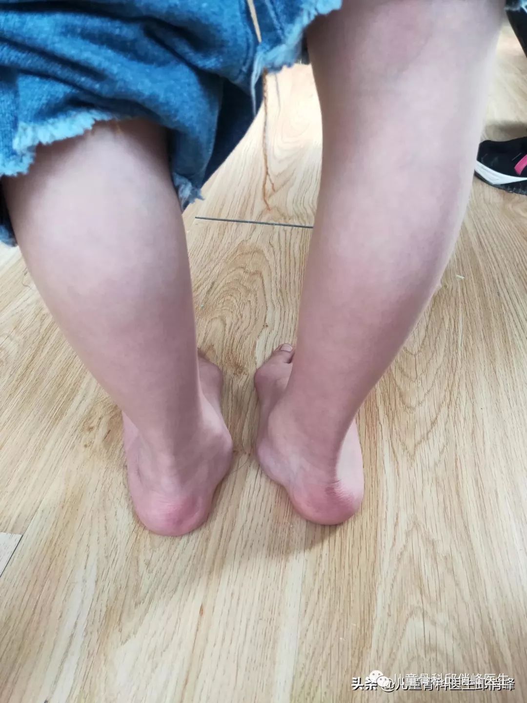 足外翻对距骨的影响,足外翻图片跖骨突出