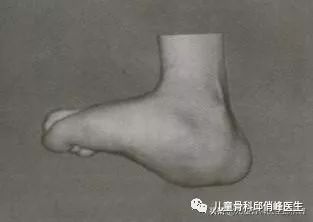 足外翻对距骨的影响,足外翻图片跖骨突出