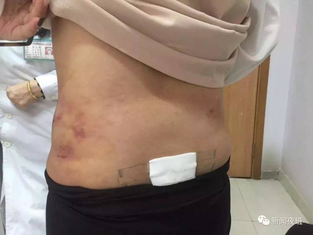 37岁女子吸脂,广西30岁姑娘吸脂