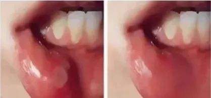 去除黄牙牙垢的牙膏,去口臭黄牙牙垢的牙膏