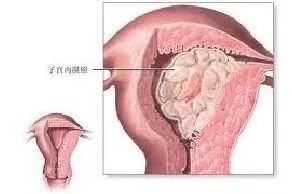 月经一年不正常是不是内膜癌,月经一直不干净内膜7cm是内膜癌吗
