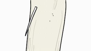 鱼刺卡住喉咙吞饭引危险,吃鱼吞了一根鱼刺开胸手术