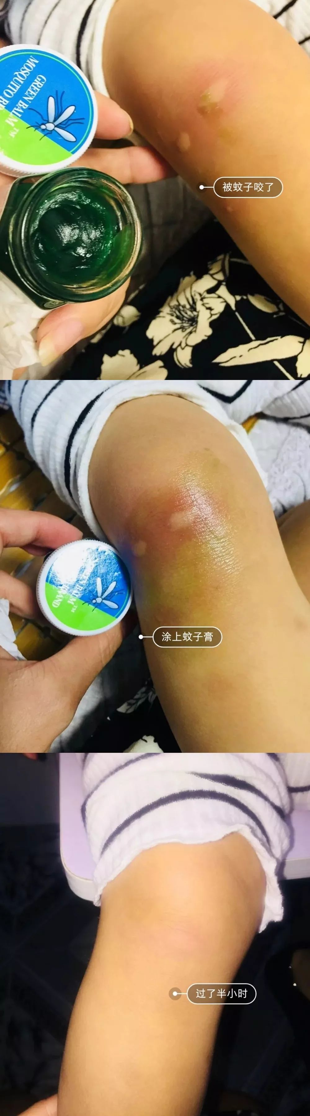 泰国防蚊虫叮咬药膏推荐,蚊子叮咬泰国青草膏哪种止痒最快