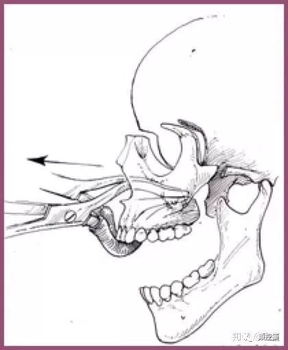 一笑就露出牙花怎么办,口呼吸导致的露龈笑如何治疗