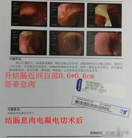 肠息肉迟发性出血与穿孔的时限,肠息肉切除后拉出血怎么治疗