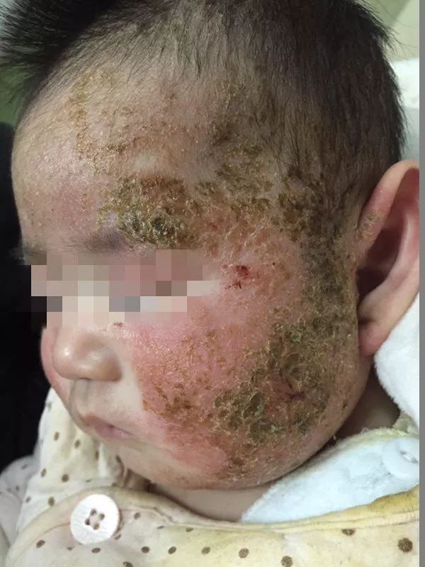 医生说湿疹不一定是坏事为什么,孩子湿疹不好一直用激素药膏