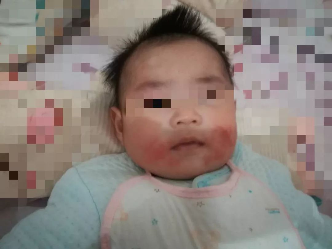 孩子湿疹总不好？医生见到都心疼了……