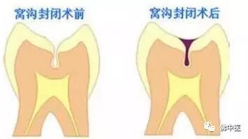 乳牙龋齿的危害及预防医师在线,有关乳牙龋病的预防