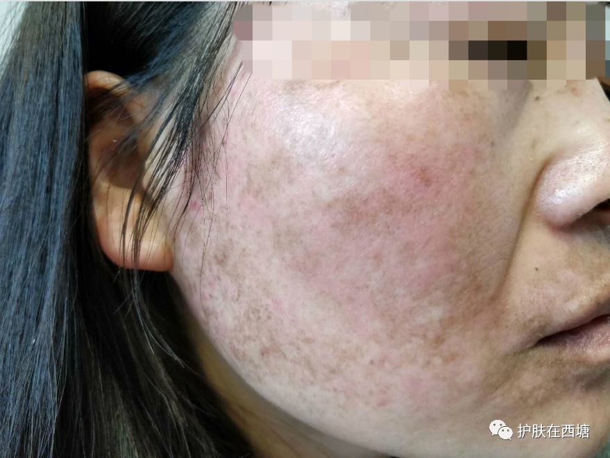 面部皮肤病科普,皮肤科普激素依赖性皮炎