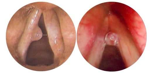 长期说话声音沙哑怎么办,感冒说不出话声音嘶哑是什么原因