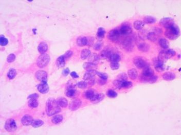 纵隔淋巴结肿大和肺结核有关吗,纵隔淋巴结肿大诊断为肺结核