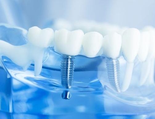 种植牙迎来曙光,种植牙早种三个月多花一万