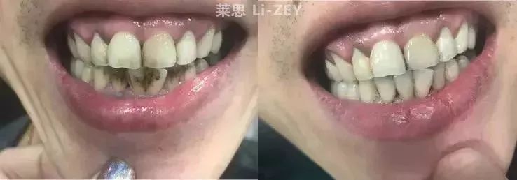 牙黄口臭的克星，有效洁白牙齿，并让口气清新！烟民必备的牙膏