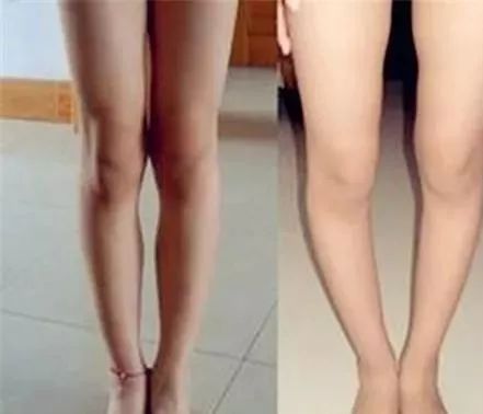 宝宝罗圈腿最佳矫正方法,罗圈腿矫正可以高几厘米