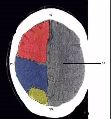 颅脑影像读片教程,颅脑影像读片怎么看