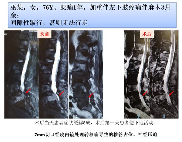 「筋骨堂」脊柱肿瘤可精准诊断，治疗选择大小皆宜