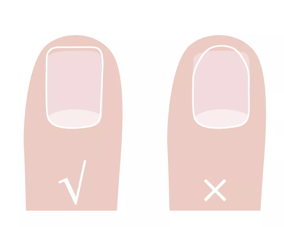 怎么治疗灰趾甲才能彻底不反复,如何快速自然地摆脱指甲真菌