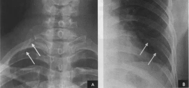 胸部ct解剖结构,胸部x线解读视频