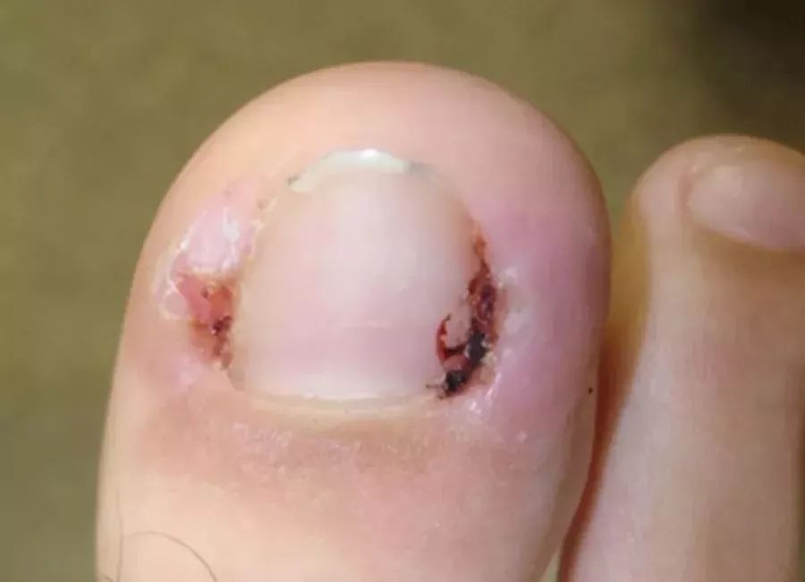 剪指甲错层,指甲该怎么剪才是正确的