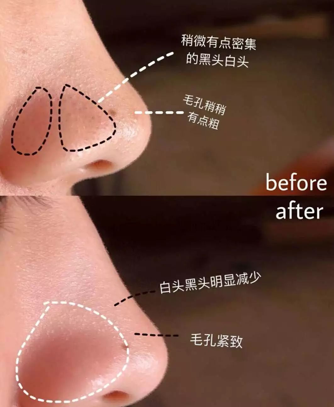 拯救毛孔黑头,清除黑头大毛孔的利器