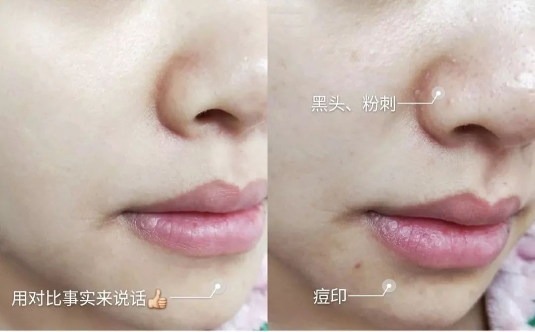 拯救毛孔黑头,清除黑头大毛孔的利器